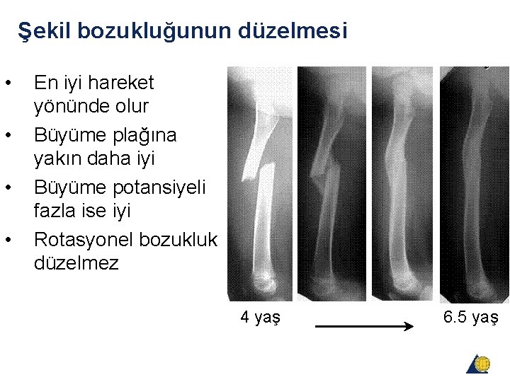 Şekil bozukluğunun düzelmesi • • En iyi hareket yönünde olur Büyüme plağına yakın daha Şekil bozukluğunun düzelmesi • • En iyi hareket yönünde olur Büyüme plağına yakın daha