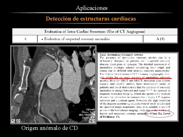 Aplicaciones Detección de estructuras cardiacas Origen anómalo de CD 