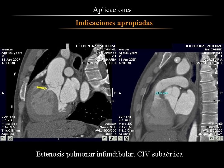 Aplicaciones Indicaciones apropiadas E Estenosis pulmonar infundibular. CIV subaórtica 