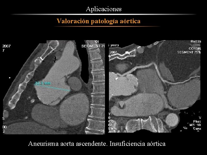 Aplicaciones Valoración patología aórtica Aneurisma aorta ascendente. Insuficiencia aórtica 