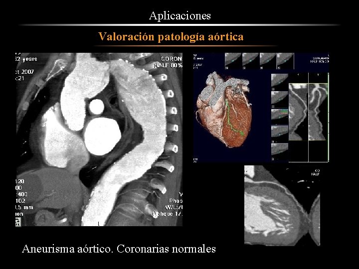 Aplicaciones Valoración patología aórtica Aneurisma aórtico. Coronarias normales 