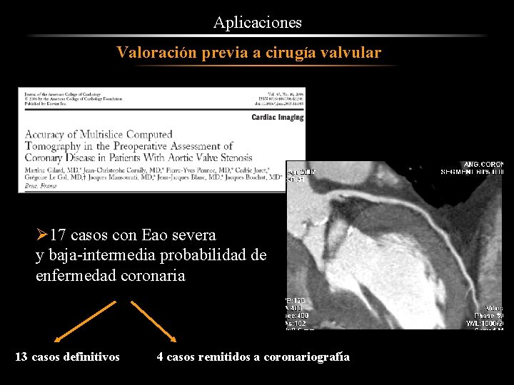 Aplicaciones Valoración previa a cirugía valvular Ø 17 casos con Eao severa y baja-intermedia