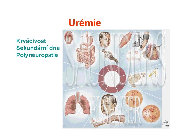Urémie Krvácivost Sekundární dna Polyneuropatie Urémie Krvácivost Sekundární dna Polyneuropatie