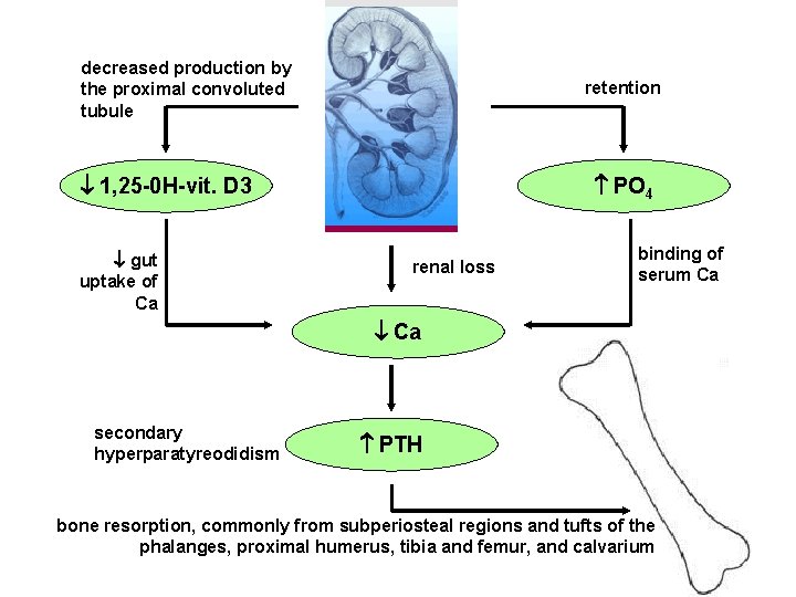 decreased production by the proximal convoluted tubule retention 1, 25 -0 H-vit. D 3 decreased production by the proximal convoluted tubule retention 1, 25 -0 H-vit. D 3