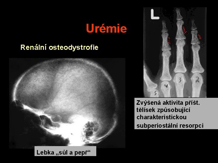 Urémie Renální osteodystrofie Zvýšená aktivita příšt. tělísek způsobující charakteristickou subperiostální resorpci Lebka „sůl a Urémie Renální osteodystrofie Zvýšená aktivita příšt. tělísek způsobující charakteristickou subperiostální resorpci Lebka „sůl a