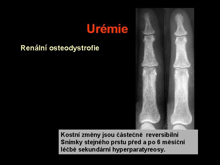 Urémie Renální osteodystrofie Kostní změny jsou částečně reversibilní Snímky stejného prstu před a po Urémie Renální osteodystrofie Kostní změny jsou částečně reversibilní Snímky stejného prstu před a po