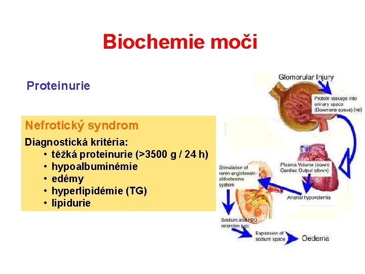 Biochemie moči Proteinurie Nefrotický syndrom Diagnostická kritéria: • těžká proteinurie (>3500 g / 24 Biochemie moči Proteinurie Nefrotický syndrom Diagnostická kritéria: • těžká proteinurie (>3500 g / 24