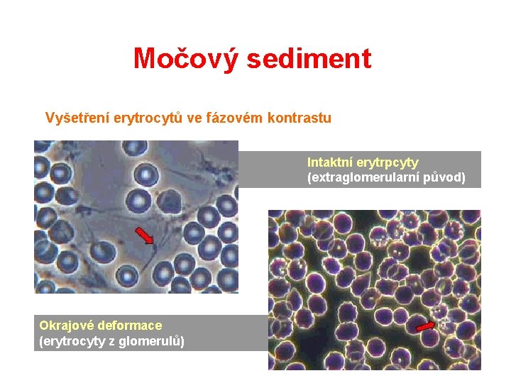 Močový sediment Vyšetření erytrocytů ve fázovém kontrastu Intaktní erytrpcyty (extraglomerularní původ) Okrajové deformace (erytrocyty Močový sediment Vyšetření erytrocytů ve fázovém kontrastu Intaktní erytrpcyty (extraglomerularní původ) Okrajové deformace (erytrocyty