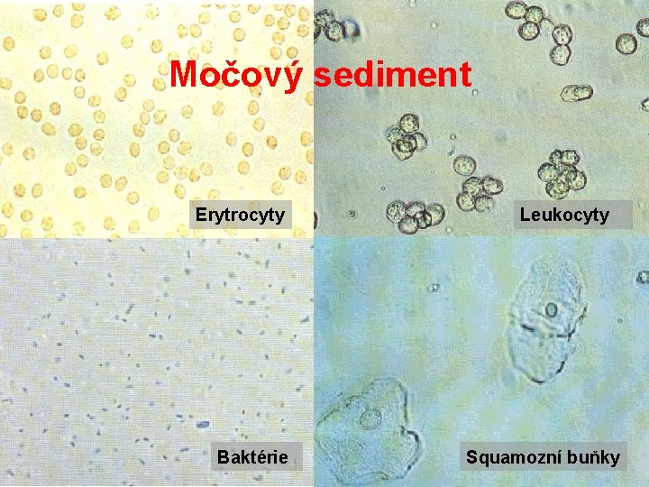 Močový sediment Erytrocyty Baktérie Leukocyty Squamozní buňky Močový sediment Erytrocyty Baktérie Leukocyty Squamozní buňky