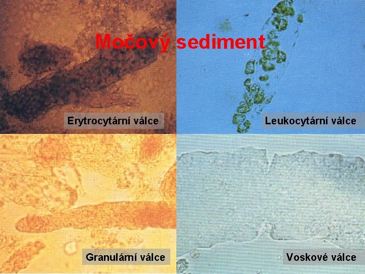 Močový sediment Erytrocytární válce Granulární válce Leukocytární válce Voskové válce Močový sediment Erytrocytární válce Granulární válce Leukocytární válce Voskové válce