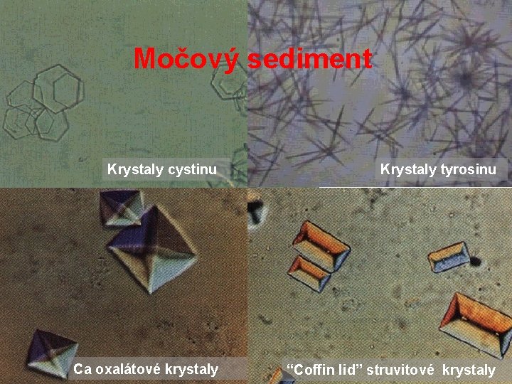 Močový sediment Krystaly cystinu Krystaly tyrosinu Ca oxalátové krystaly “Coffin lid” struvitové krystaly Močový sediment Krystaly cystinu Krystaly tyrosinu Ca oxalátové krystaly “Coffin lid” struvitové krystaly