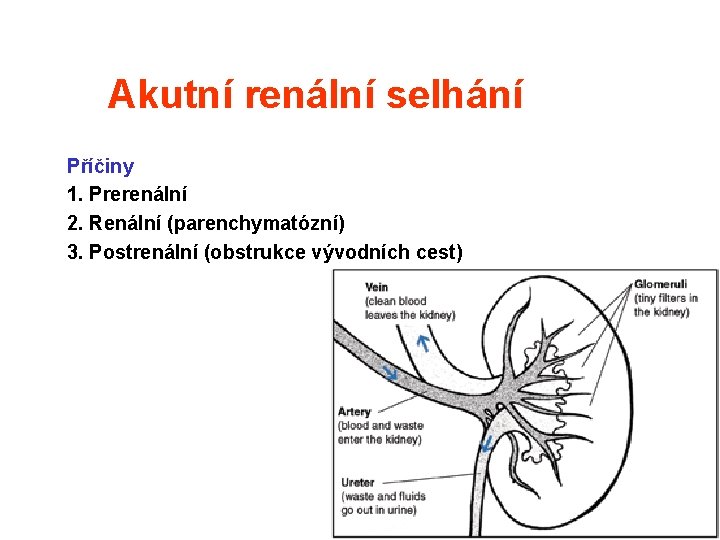 Akutní renální selhání Příčiny 1. Prerenální 2. Renální (parenchymatózní) 3. Postrenální (obstrukce vývodních cest) Akutní renální selhání Příčiny 1. Prerenální 2. Renální (parenchymatózní) 3. Postrenální (obstrukce vývodních cest)