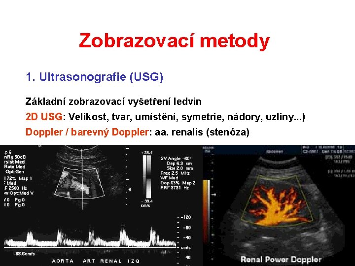 Zobrazovací metody 1. Ultrasonografie (USG) Základní zobrazovací vyšetření ledvin 2 D USG: Velikost, tvar, Zobrazovací metody 1. Ultrasonografie (USG) Základní zobrazovací vyšetření ledvin 2 D USG: Velikost, tvar,
