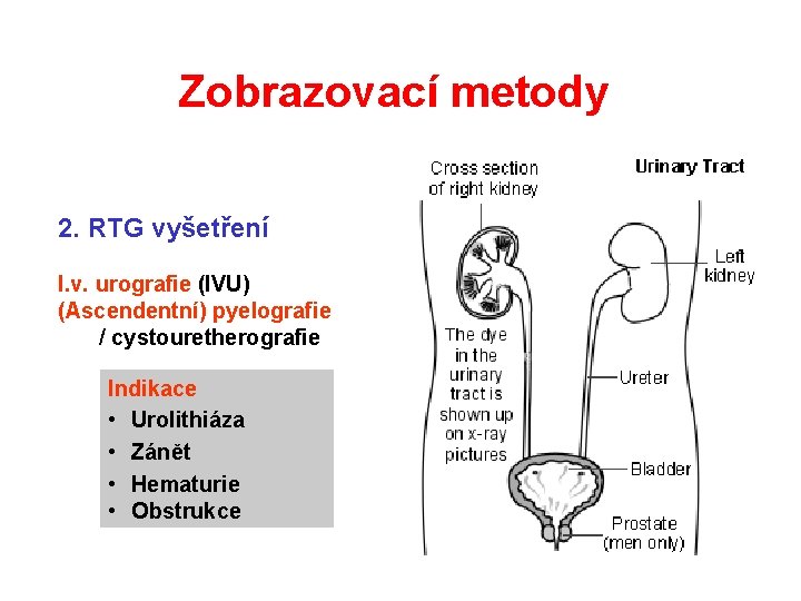 Zobrazovací metody 2. RTG vyšetření I. v. urografie (IVU) (Ascendentní) pyelografie / cystouretherografie Indikace Zobrazovací metody 2. RTG vyšetření I. v. urografie (IVU) (Ascendentní) pyelografie / cystouretherografie Indikace