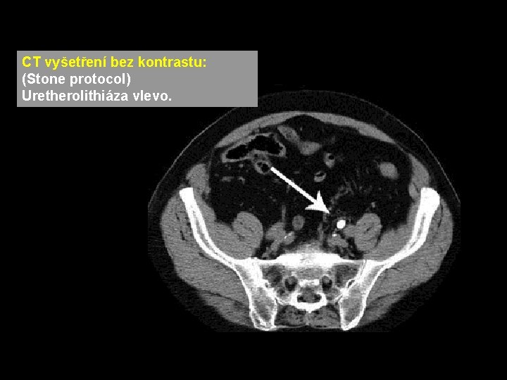 CT vyšetření bez kontrastu: (Stone protocol) Uretherolithiáza vlevo. CT vyšetření bez kontrastu: (Stone protocol) Uretherolithiáza vlevo.