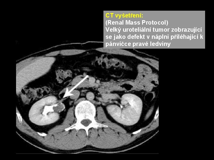 CT vyšetření: (Renal Mass Protocol) Velký uroteliální tumor zobrazující se jako defekt v náplni CT vyšetření: (Renal Mass Protocol) Velký uroteliální tumor zobrazující se jako defekt v náplni