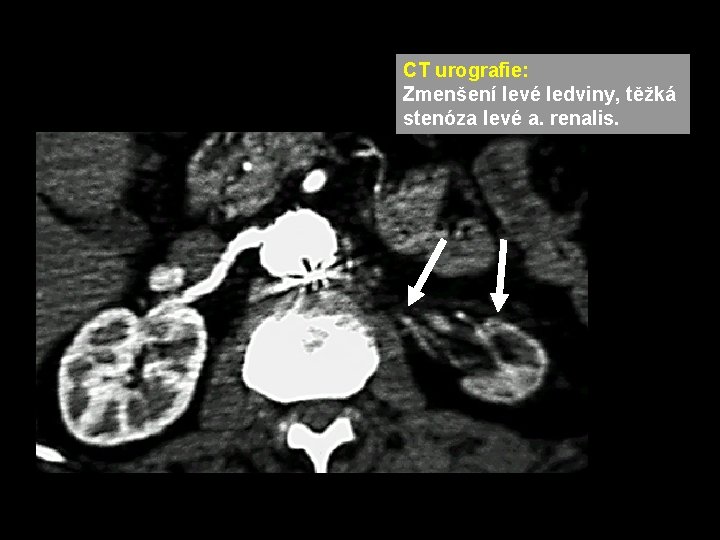CT urografie: Zmenšení levé ledviny, těžká stenóza levé a. renalis. CT urografie: Zmenšení levé ledviny, těžká stenóza levé a. renalis.