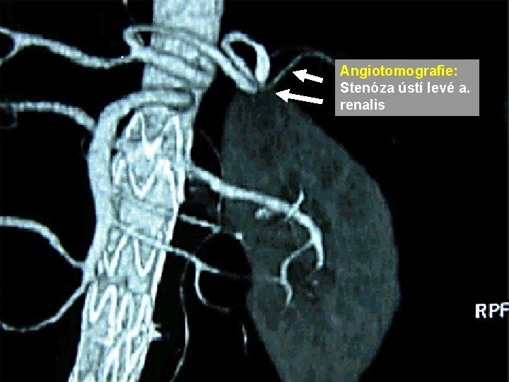 Angiotomografie: Stenóza ústí levé a. renalis Angiotomografie: Stenóza ústí levé a. renalis