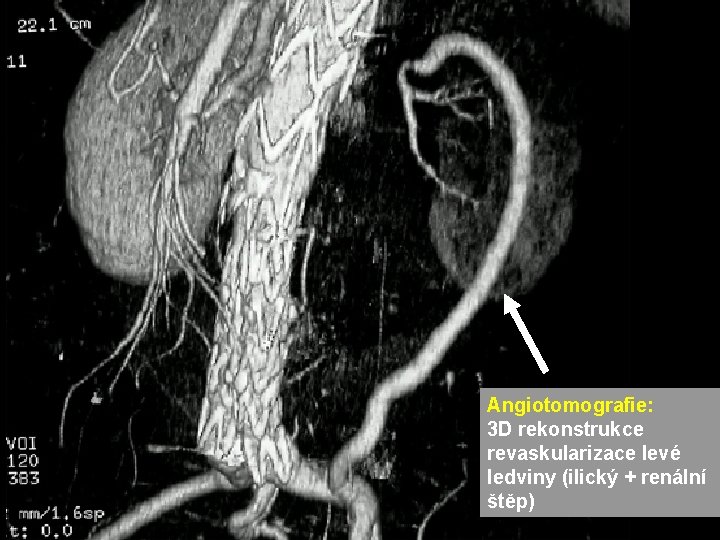 Angiotomografie: 3 D rekonstrukce revaskularizace levé ledviny (ilický + renální štěp) Angiotomografie: 3 D rekonstrukce revaskularizace levé ledviny (ilický + renální štěp)