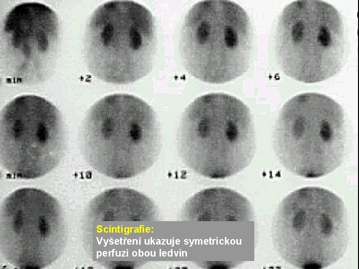 Scintigrafie: Vyšetření ukazuje symetrickou perfuzi obou ledvin Scintigrafie: Vyšetření ukazuje symetrickou perfuzi obou ledvin