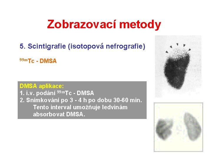 Zobrazovací metody 5. Scintigrafie (isotopová nefrografie) 99 m. Tc - DMSA aplikace: 1. i. Zobrazovací metody 5. Scintigrafie (isotopová nefrografie) 99 m. Tc - DMSA aplikace: 1. i.