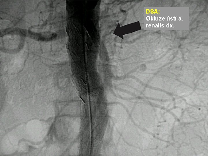 DSA: Okluze ústí a. renalis dx. DSA: Okluze ústí a. renalis dx.