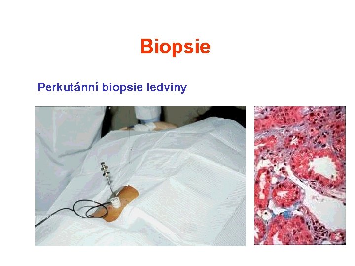 Biopsie Perkutánní biopsie ledviny Biopsie Perkutánní biopsie ledviny