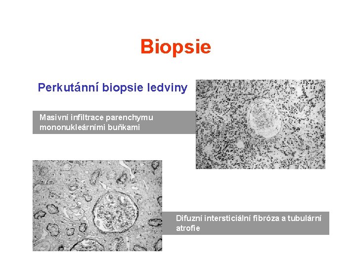 Biopsie Perkutánní biopsie ledviny Masivní infiltrace parenchymu mononukleárními buňkami Difuzní intersticiální fibróza a tubulární Biopsie Perkutánní biopsie ledviny Masivní infiltrace parenchymu mononukleárními buňkami Difuzní intersticiální fibróza a tubulární