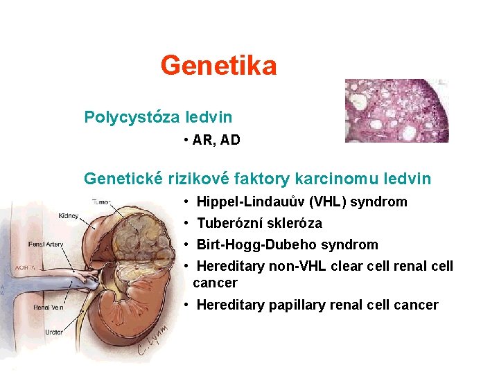 Genetika Polycystóza ledvin • AR, AD Genetické rizikové faktory karcinomu ledvin • Hippel-Lindauův (VHL) Genetika Polycystóza ledvin • AR, AD Genetické rizikové faktory karcinomu ledvin • Hippel-Lindauův (VHL)