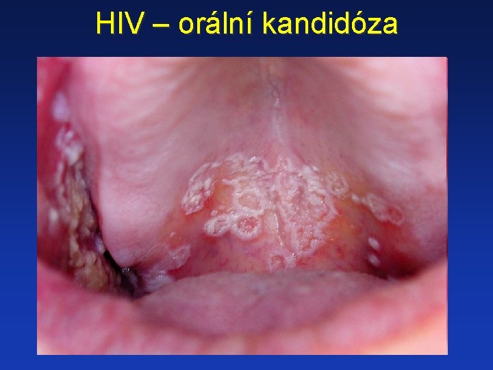 HIV – orální kandidóza 