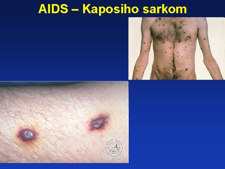 AIDS – Kaposiho sarkom 