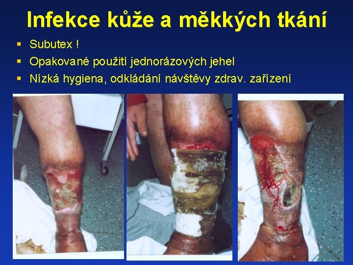 Infekce kůže a měkkých tkání § § § Subutex ! Opakované použití jednorázových jehel