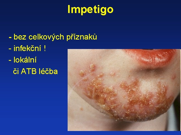 Impetigo - bez celkových příznaků - infekční ! - lokální či ATB léčba 