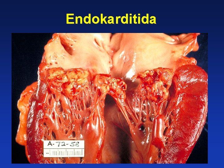 Endokarditida 