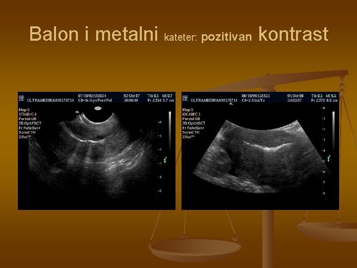 Balon i metalni kateter: pozitivan kontrast 