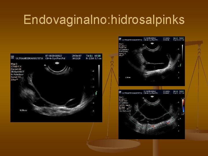 Endovaginalno: hidrosalpinks 