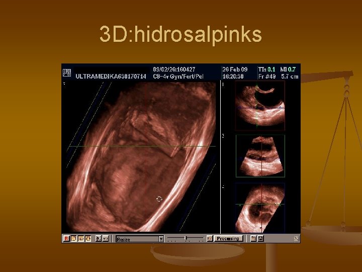 3 D: hidrosalpinks 