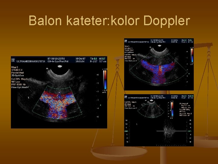 Balon kateter: kolor Doppler 