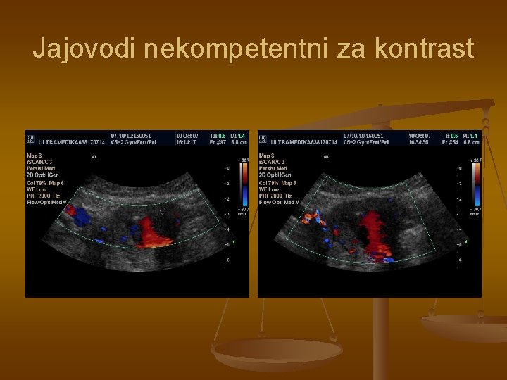 Jajovodi nekompetentni za kontrast 