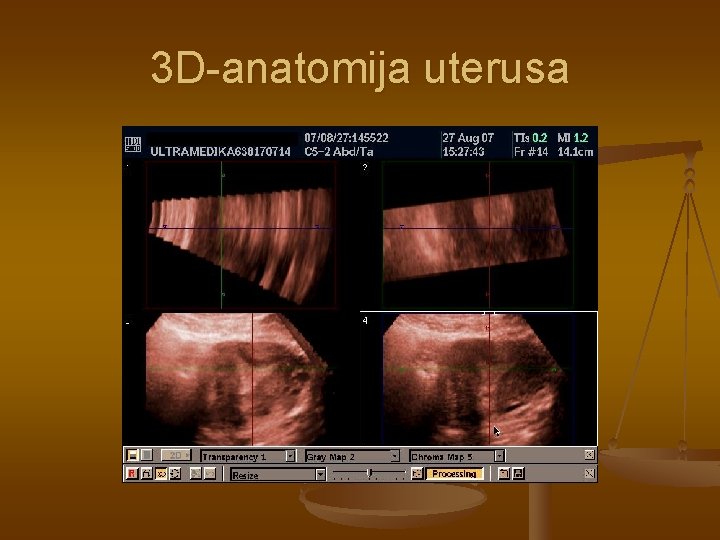 3 D-anatomija uterusa 