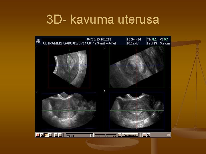 3 D- kavuma uterusa 