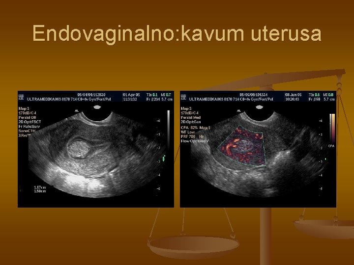 Endovaginalno: kavum uterusa 