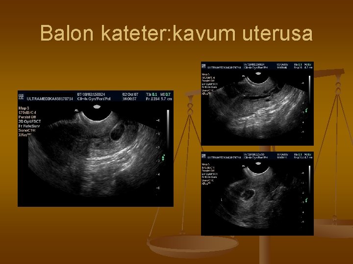 Balon kateter: kavum uterusa 