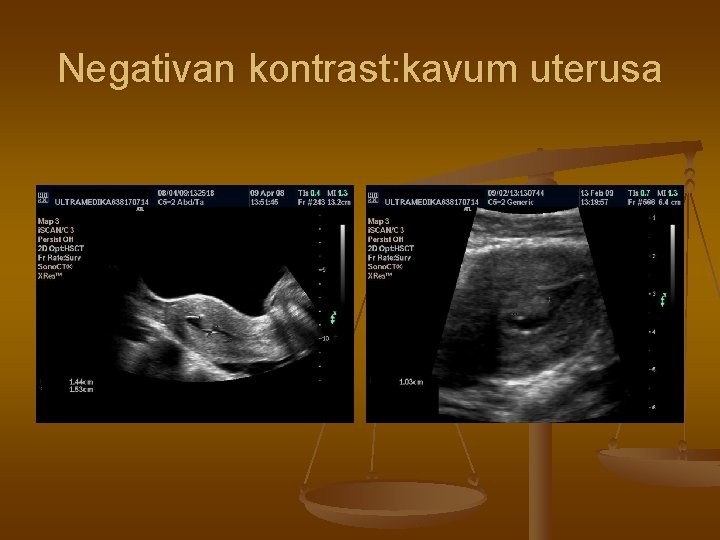 Negativan kontrast: kavum uterusa 