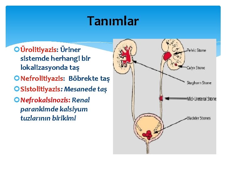 Tanımlar Ürolitiyazis: Üriner sistemde herhangi bir lokalizasyonda taş Nefrolitiyazis: Böbrekte taş Sistolitiyazis: Mesanede taş