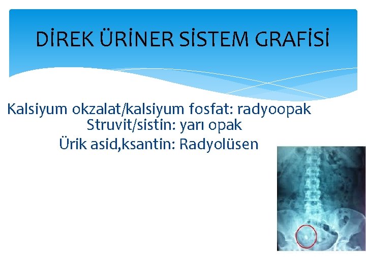 DİREK ÜRİNER SİSTEM GRAFİSİ Kalsiyum okzalat/kalsiyum fosfat: radyoopak Struvit/sistin: yarı opak Ürik asid, ksantin: