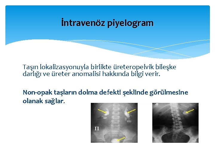 İntravenöz piyelogram Taşın lokalizasyonuyla birlikte üreteropelvik bileşke darlığı ve üreter anomalisi hakkında bilgi verir.