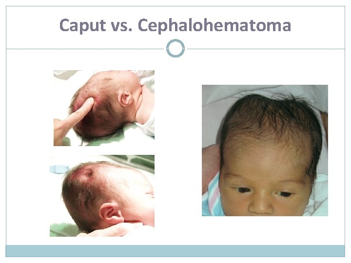 Caput vs. Cephalohematoma 