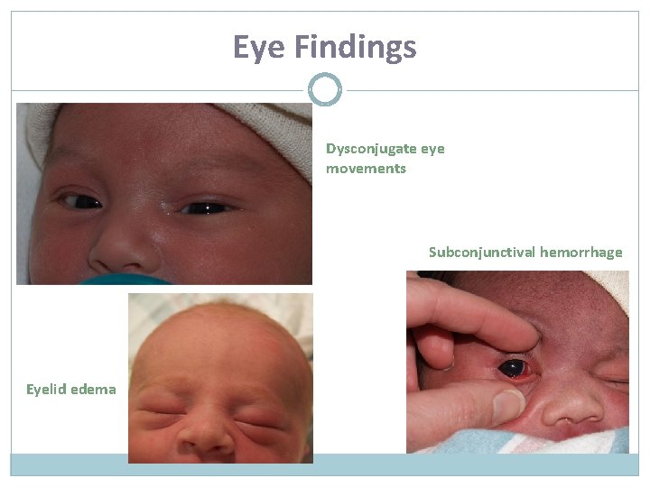 Eye Findings Dysconjugate eye movements Subconjunctival hemorrhage Eyelid edema 