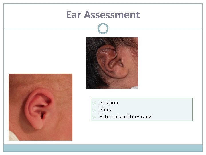 Ear Assessment o Position o Pinna o External auditory canal 